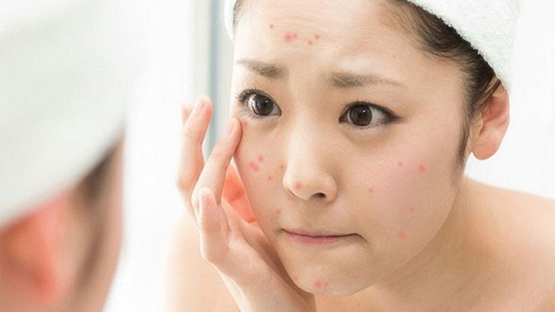 Tình trạng da nổi mụn có liên quan đến việc ăn bánh mì