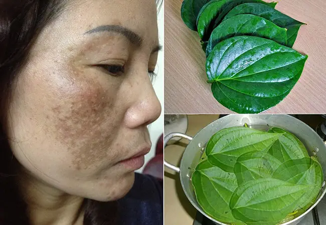Cách Nấu Lá Trầu Không Trị Nám An Toàn Và Hiệu Quả