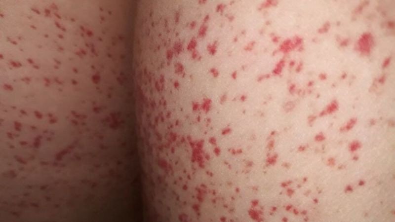 Cỏ mần trầu được sử dụng trong bài thuốc chữa mẩn đỏ