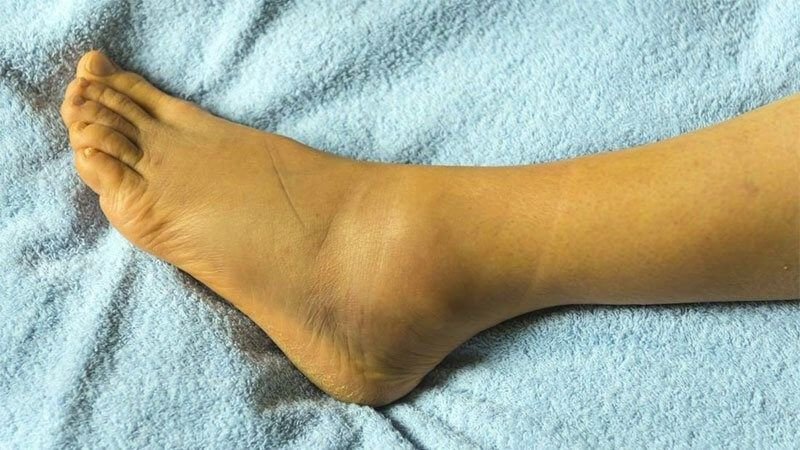 Cỏ mần trầu được sử dụng trong bài thuốc hỗ trợ trị viêm gan gây vàng da