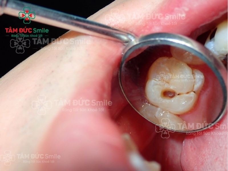 Sâu răng là nguyên nhân phổ biến gây ra mùi hôi miệng và cần được điều trị kịp thời